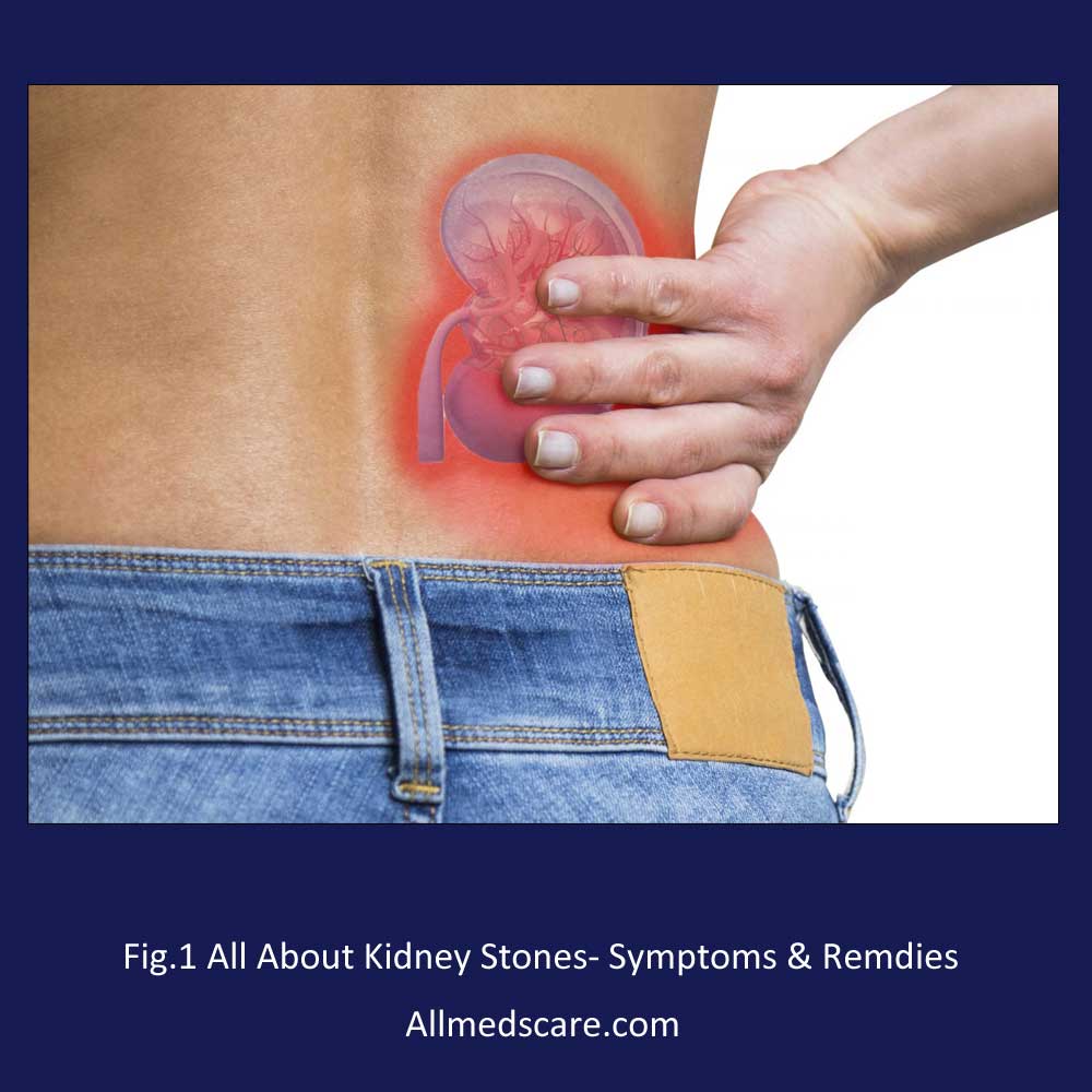 Best foods to avoid for kidney stone - Allmedscare.com