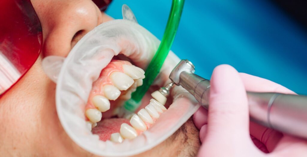 5 Surprising Benefits of Regular Teeth Cleaning in Marietta - Posts Content