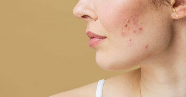 Kako se rešiti bubuljica brzo i efikasno? 6 proverenih metoda! | Galen Pharm On-line