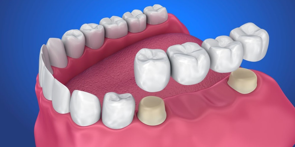 Dental Crowns and Bridges Market Growth (Status and Outlook) | Opportunities and Challenges | Industry Size, Share, Reve