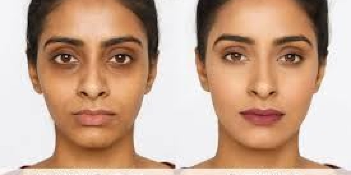 Best Dark Circles Treatment Ghaziabad – Get Brighter Eyes with Expert Care