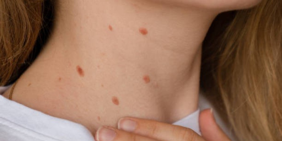 Transform Your Skin with Advanced Mole Removal Innovations