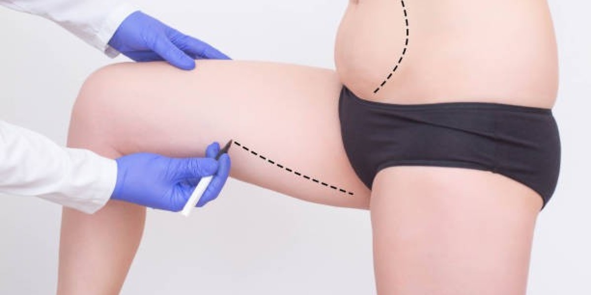 Managing Pain and Swelling After Liposuction in Riyadh