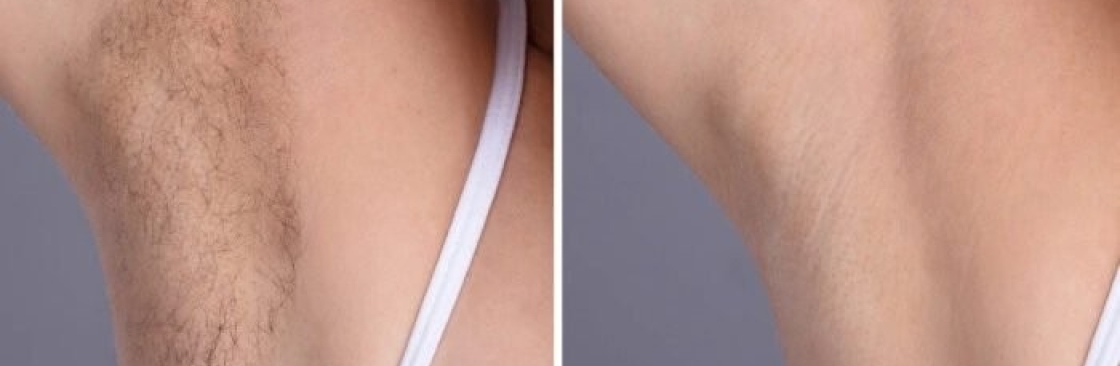 Laser Hair Removal Cover Image