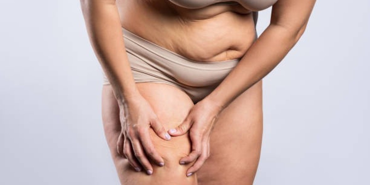 Future of Lipedema Research and Hope Ahead