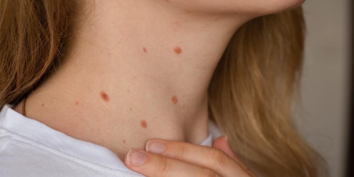 Understanding Are Skin Tags Contagious Myths and Facts