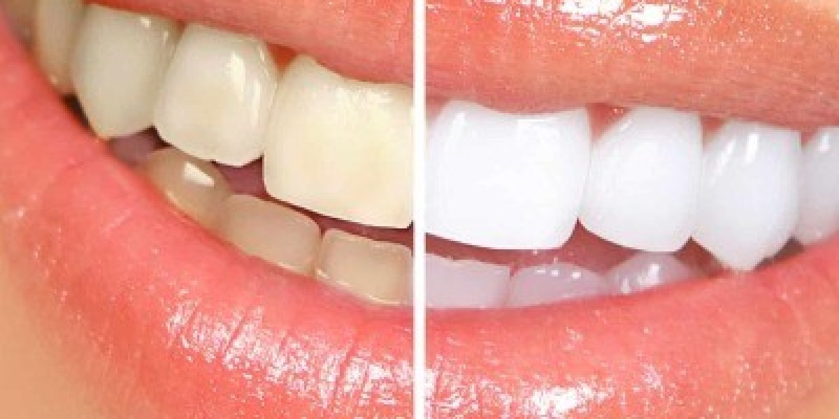 Teeth Whitening in Islamabad: Whitening for Special Occasions