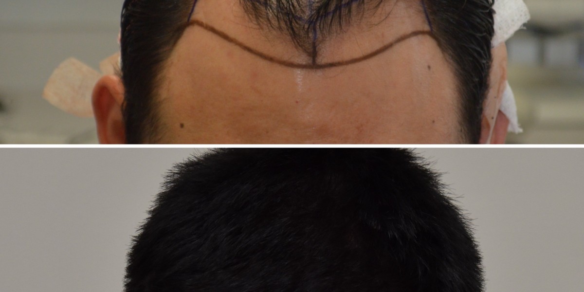 Stem Cell Hair Growth in New York