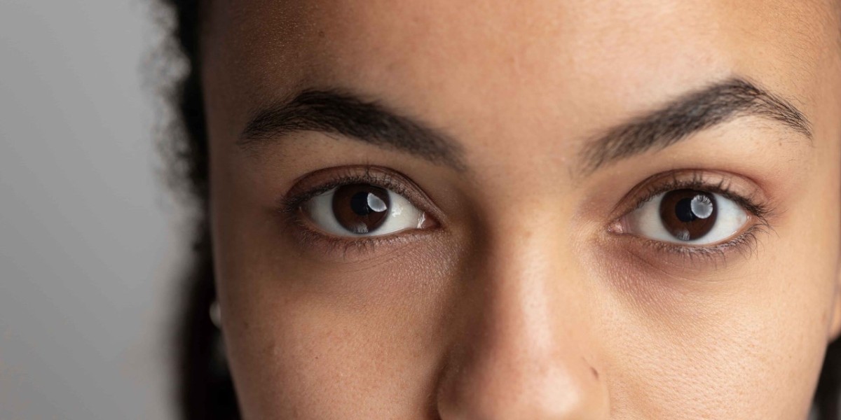 Dark Circles Treatment for Sensitive Skin: What Works Best