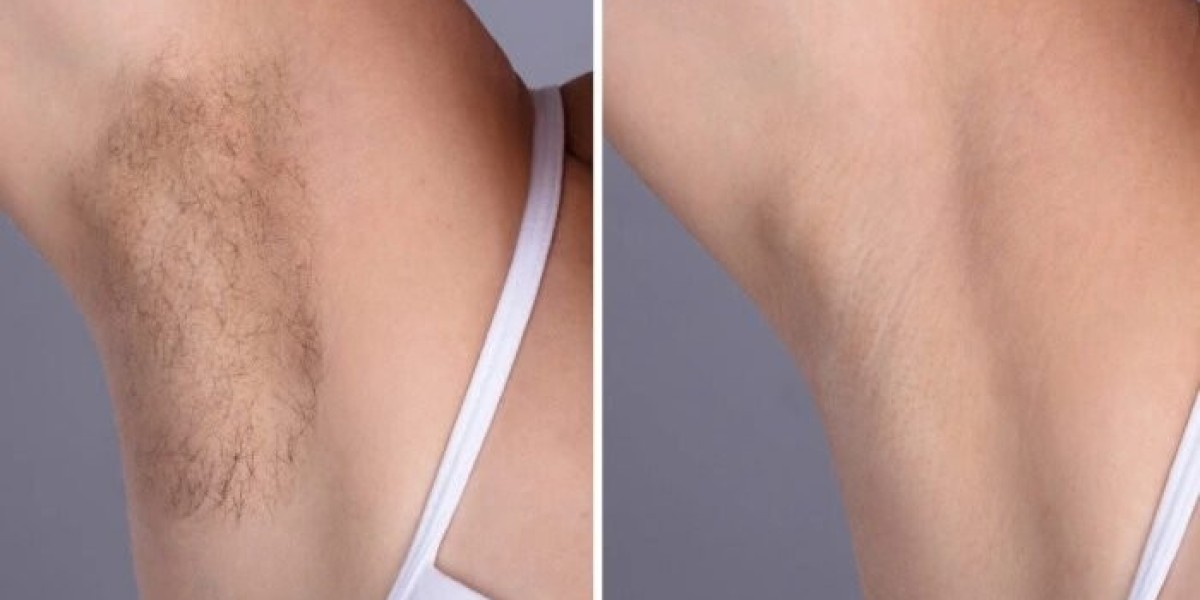 Best Aesthetic Clinics in Dubai for Laser Hair Removal on Face and Body
