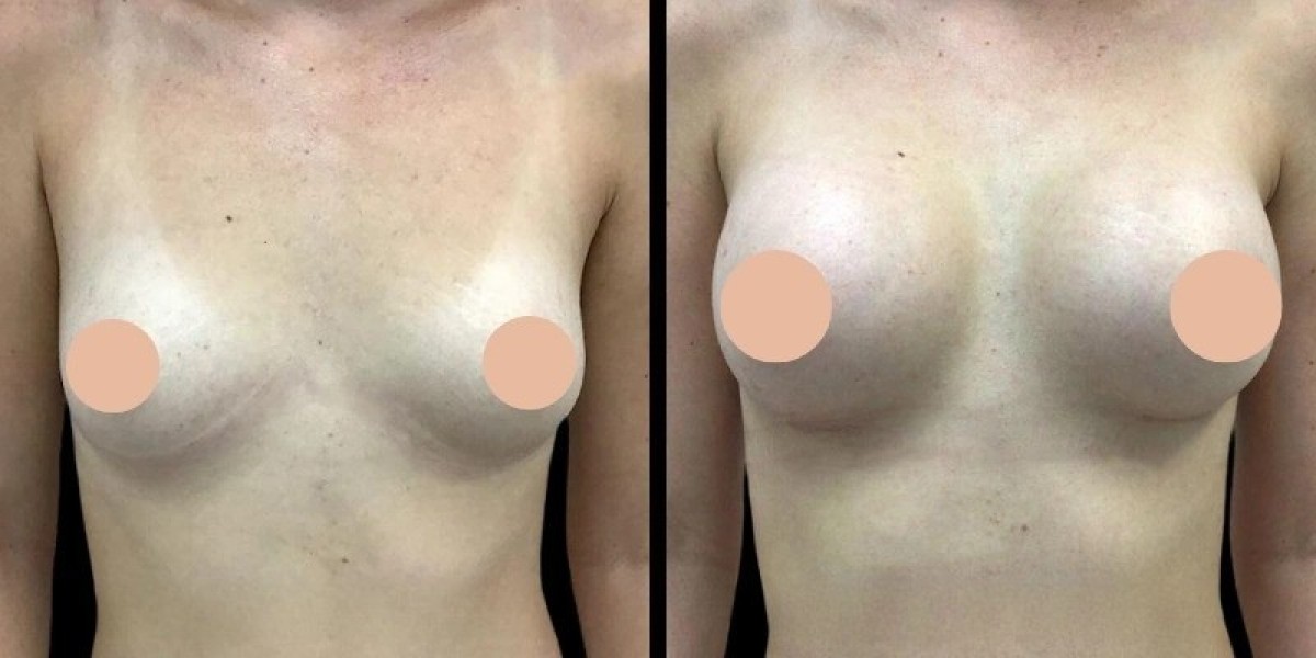 Recovery Advice from the Best breast augmentation Surgeon in Dubai