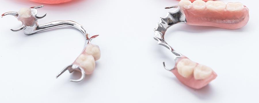 Metalne vizil proteze | Dental SPA centar Niš