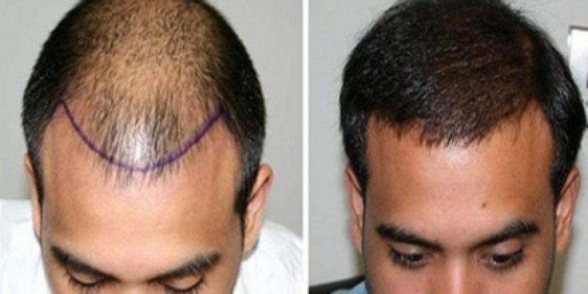 زراعة الشعر في الرياض: استثمار طويل الأمد في مظهرك وجاذبيتك