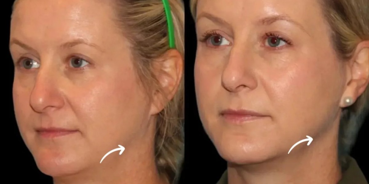Chin Contouring With Sculptra Treatments in Dubai