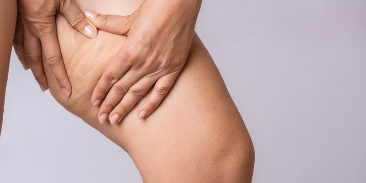 Lipedema Treatment That Supports Mobility and Comfort