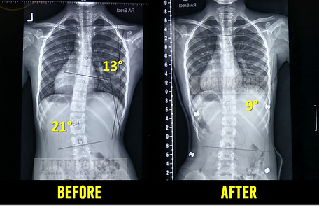 Scoliosis Brace for Singapore Adults | Body Brace for Scoliosis