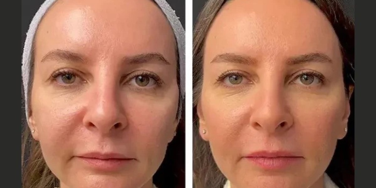 Mesotherapy Treatment in Dubai Restoring Youthful Skin Naturally