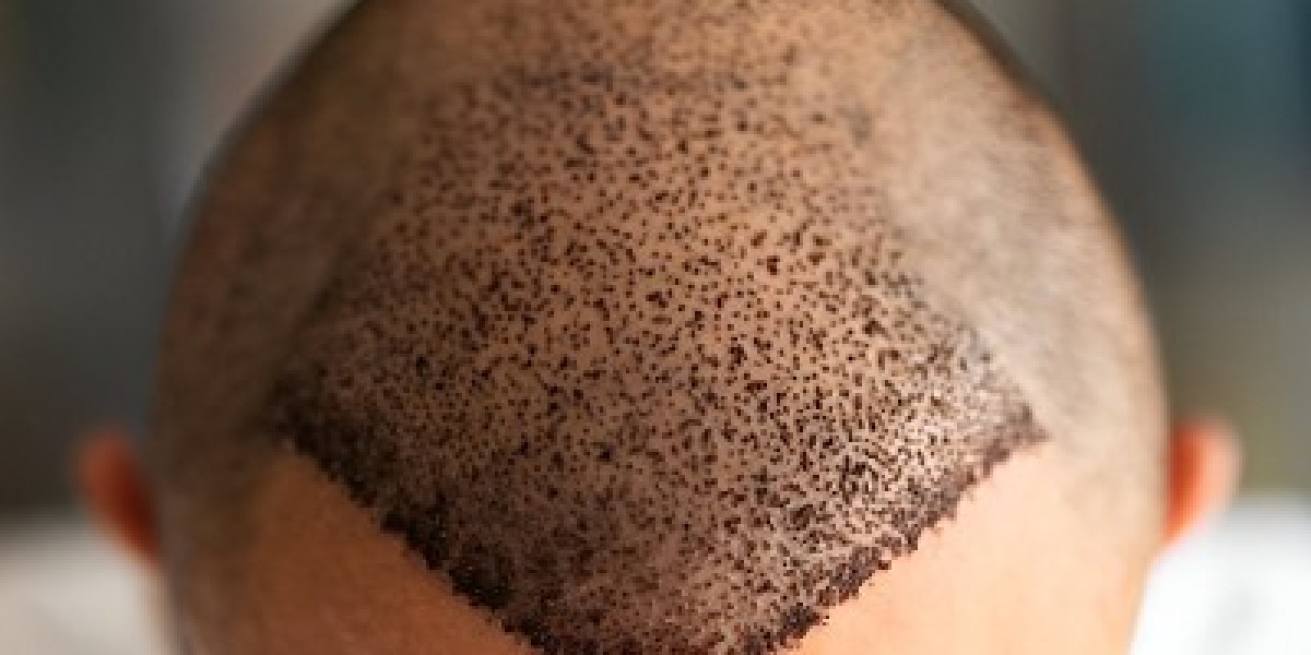 Step-by-Step Procedure of Hair Transplant in Islamabad Explained