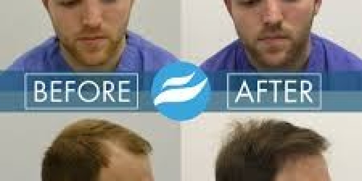 A Practical Guide to Modern Hair Restoration and Transplant Solutions