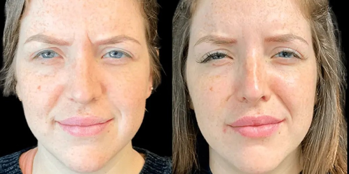 Botox in Dubai for Forehead Lines Treatment