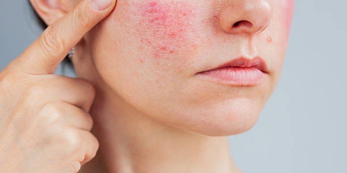 Laser Acne Treatment Process: From Consultation to Stunning Results