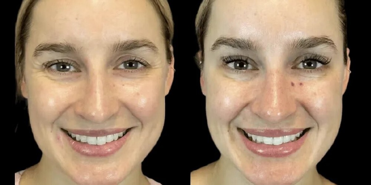 How the Best Plastic Surgeons in Dubai Customize Botox for Different Skin Types