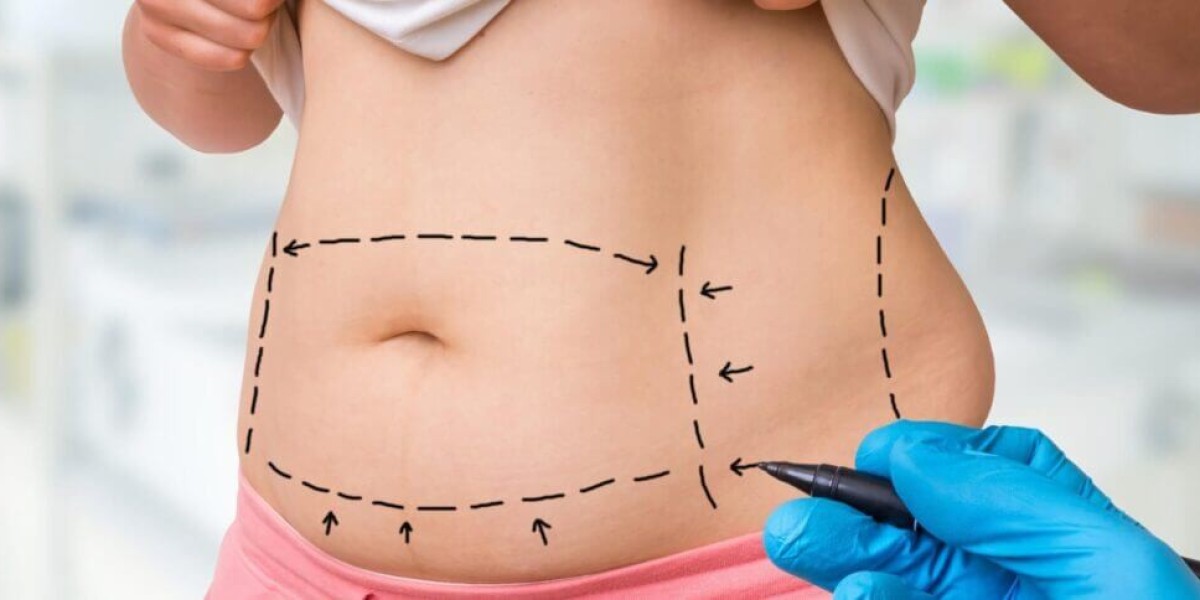 How Mini Tummy Tuck Dubai Helps After Weight Loss