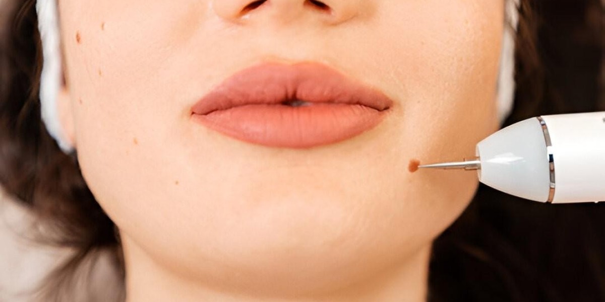 Pain-Free Wart Removal in Islamabad – Quick Results