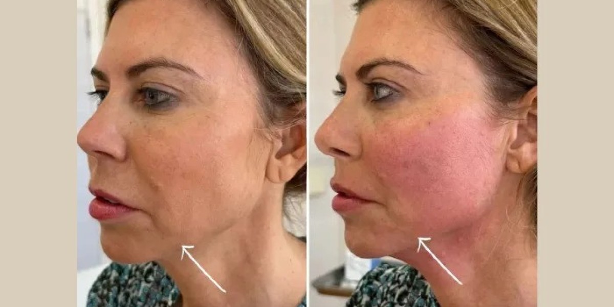 What to Expect During Endolift Treatment with Best Plastic Surgeons in dubai